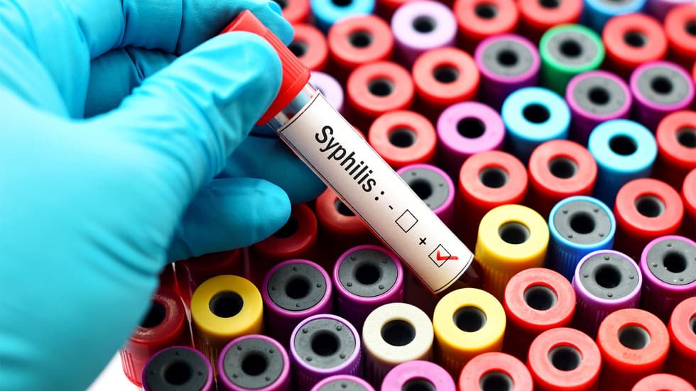 sifilis kasalligi